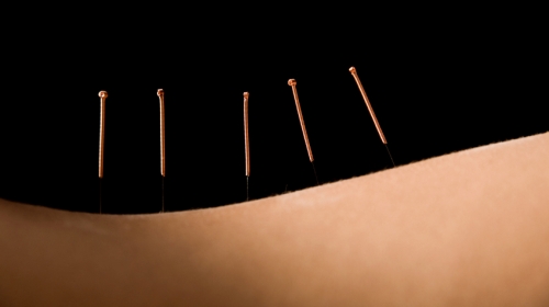 Acupuncture