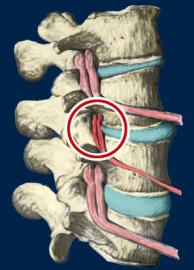 Subluxation